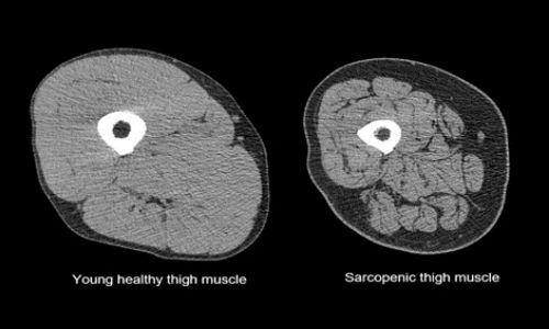 Difference of Thigh Muscle between Young and Sarcopenia