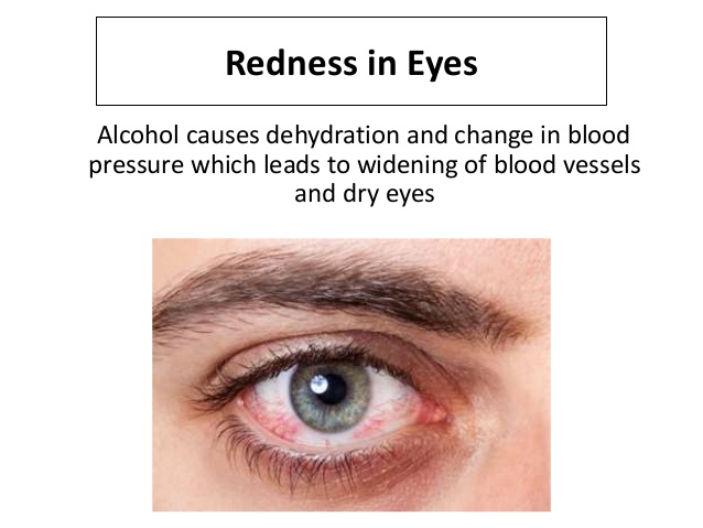 effects-of-alcohol-on-eyes-4-638